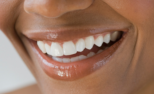 Dental Crowns
